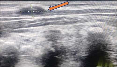 1.8 × 1.2 cm anechoic lesion in the subcutaneous plane with a small intramuscular extension.