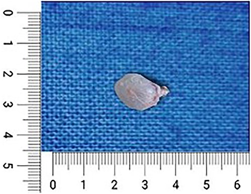 Intraoperative resected specimen during the open biopsy.