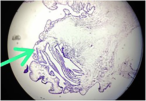 Hematoxylin-and-eosin-stained histopathology slide, showing cuticle, with subcuticular cells and chronic inflammatory infiltrate suggestive of cysticercosis.