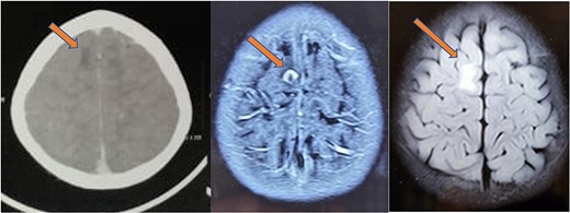 CT (left) showing a hypodense lesion in the right frontal lobe, T1 post-contrast MRI image (center) showing a ring enhancing lesion in the right frontal lobe and FLAIR image (right) showing non-enhancing vasogenic edema surrounding the lesion.