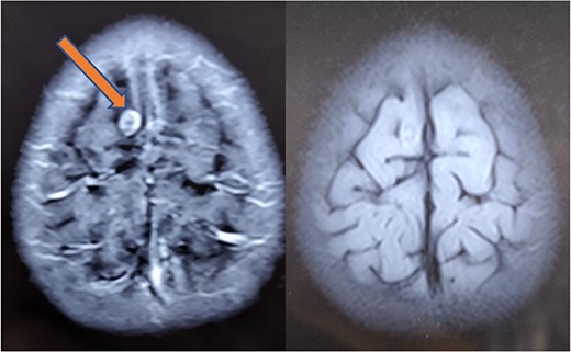 Repeat MRI at 6 months showing resolved changes with reduction in size of the lesion with resolution of perilesional edema.