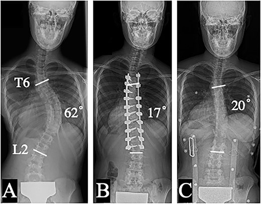 Posteroanterior plain radiographs in a standing position: preoperative (A), and 1 year after posterior corrective surgery from T5 to L2 (B); 1 year after implant removal (C).