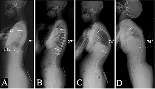 Lateral plain radiographs in a standing position: preoperative (A), and 1 year after posterior corrective surgery from T5 to L2 (B); 1 year (C) after implant removal; dorsal flexion in the supine position before revision surgery (D).