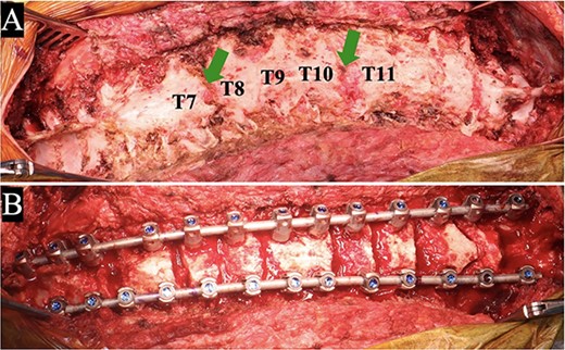 Intraoperative findings of revision surgery: solid bony fusion was confirmed except at T7/8 and T10/11 levels (arrows) (A); after correction with multilevel osteotomies (B).