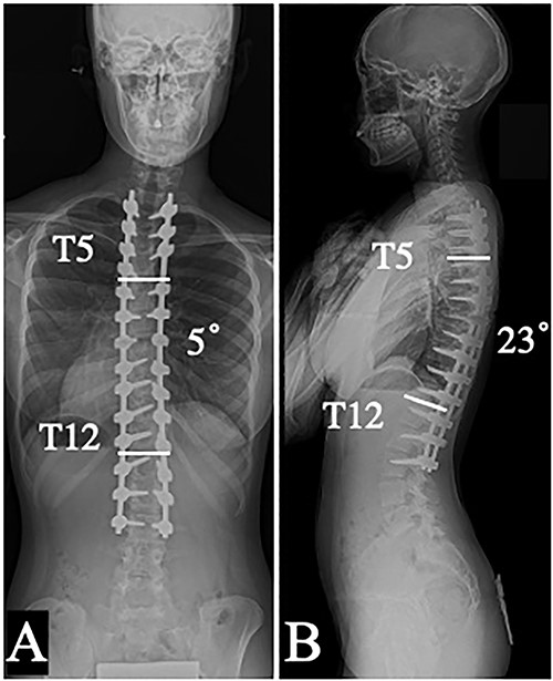 Coronal (A) and sagittal (B) plain radiographs in a standing position taken 14 months after the revision surgery.