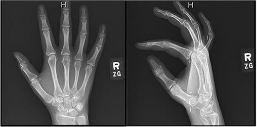 Right hand imaging 1-month status post revision CTR demonstrating hemoclip placement with initial asymptomatic migration of a single clip to the small finger proximal interphalangeal joint.