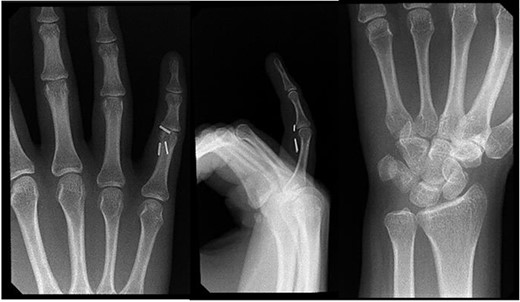 Right hand imaging 4-months status post revision CTR demonstrating symptomatic triple hemoclip migration into the volar aspect of the small digit.