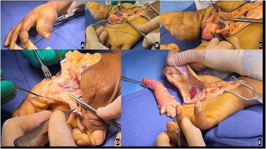 Preoperative and intraoperative images of the macrodactyly: (A) preoperative pictures demonstrating the isolated macrodactyly of the thumb and index finger; (B) scissor is outlining the normal digital nerve to the thumb, which then expands into a lipofibromatous hamartoma (LFH) outlined by the Adson forceps; (C) zoom image demonstrating the difference in the normal radial digital nerve to the thumb and the LFH involved ulnar digital nerve to the thumb; (D) similar image of the normal radial digital nerve to the index finger, expanding into the LFH tumor driving the macrodactyly as noted by the scissors; (E) resection of the LFH tumor of the ulnar digital nerve of the thumb and associated debulking.