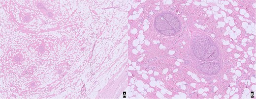 H&E slide from representative sections: (A) low power view of unremarkable skin and subcutaneous tissue with benign nerve branches showing expansion of epineurium; (B) high power view showing expansion of epineurium by adipose tissue and fibrous tissue.