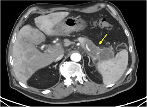 CT scan with IV contrast: axial image showing hypoenhancing infiltrative pancreatic tail mass with central necrosis (arrow), measuring 8 × 3 × 4 cm with adjacent stranding and mass abutting the spleen that appears to completely encase the splenic artery and vein.