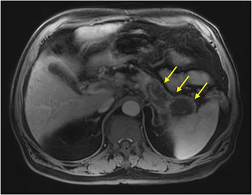 MRI abdomen (MRCP) with IV contrast: axial image showing diffuse enlarged hypointense signal of pancreatic body and tail on T1 weighted imaging encircled by a thin rim of enhancement representing normal pancreatic tissue (arrows).