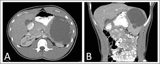 Preoperative (A) axial and (B) coronal abdominal CT images showing complex cystic splenic mass.