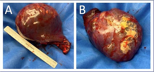 Splenectomy specimen with intact capsule with underlying cystic structure. (A) Anterior surface; (B) Posterior surface.