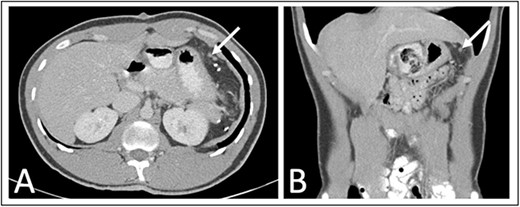 One year post operative abdominal CT scan (A) axial and (B) coronal abdominal CT images showing several sub-centimeter nodules in the post-splenectomy bed (arrows).