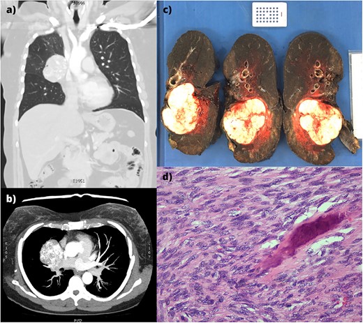 (a,b) CT imaging showing a large right hilar mass with compression of right main bronchus and superior vena cava. (c) Macroscopic appearance of the right lung containing the tumour and adjacent mediastinal structures. (d) Histopathology of the metastatic osteosarcoma, demonstrating atypical spindle cell morphology.