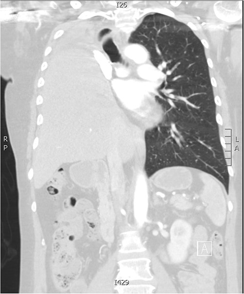Follow-up CT imaging demonstrating complete migration of the liver into the right thoracic cavity.