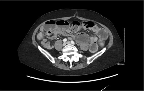CT scan demonstrating dilated loops of small bowel with air fluid levels with distal decompressed loops.