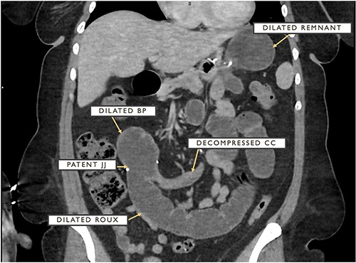 CT cross-section demonstrating dilated remnant stomach, BP limb and roux limb as well as a patent JJ anastomosis with a distally decompressed CC.