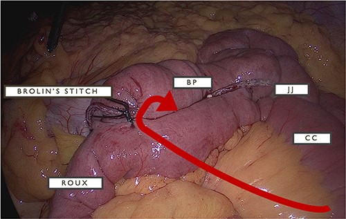 The arrow depicts the location of defect enabling herniation of CC between JJ anastomosis and Brolin’s stitch with relative locations for BP and roux limbs.