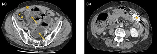 Axial computed tomography images showing small bowel obstruction with a transition point in the anterior right iliac fossa (cross). There are distended small bowel loops proximally with air-fluid levels and faecalised contents (arrows); and collapsed small bowel loops distally (arrow heads). The ICD is located intraperitoneally (star).