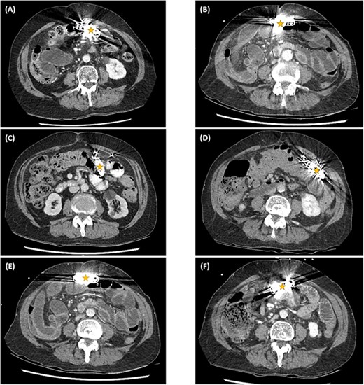 Serial computed tomography studies from the six episodes of SBOs showing the abdominal ICD device (star) in a different intraperitoneal location each time — in March (A), April (B), and November (C) of 2019; November (D) and December (E) of 2020; and January (F) of 2021.