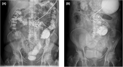 X-ray plain films of the abdomen showing passage of Gastrografin into the colon and rectum during the first admission (A); and the non-progression of Gastrografin in the stomach during the third admission (B).