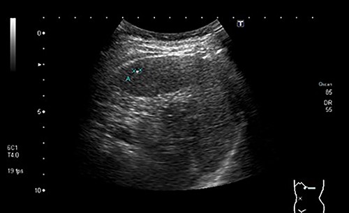 Ultrasound showing a hypoechoic nodule, vaguely heterogeneous, located in segment VII, subcapsular, and with ~22 mm in diameter.