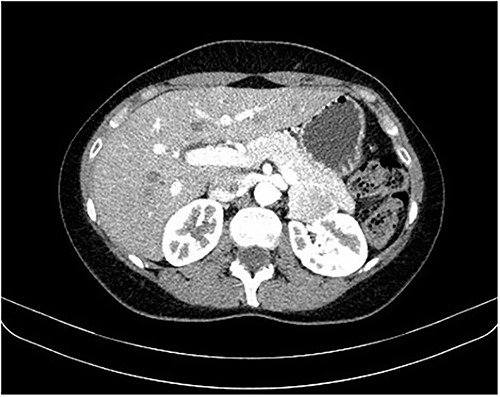 CT scan showing, in addition to signs of chronic liver disease, the presence of a solid subcapsular nodule of segment VII, measuring 23 mm, with hypervascular behavior in the arterial phase.