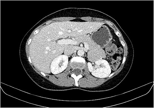 CT scan showing the same mass as shown in Fig. 2 but with washout in the portal venous phase.