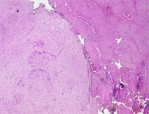 Liver parenchyma partially occupied by a neoplastic proliferation with expansive borders.