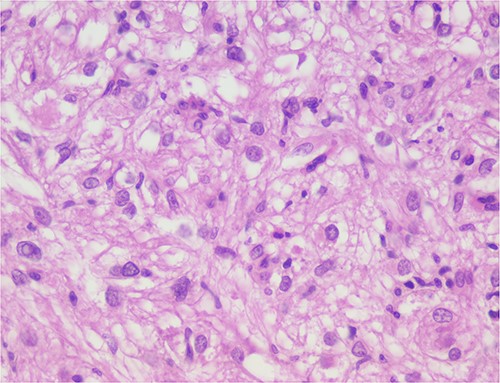The neoplastic cells are organized in small bundles. The cells are spindled to oval, with eosinophilic and granular cytoplasm and with mild nuclear atypia.