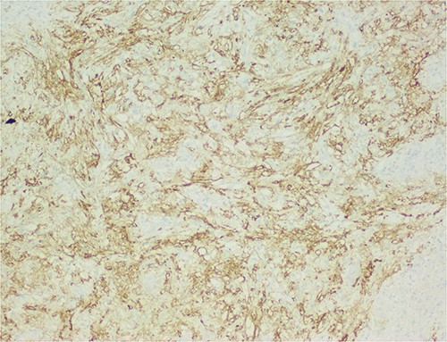 There is heterogeneous positivity for smooth muscle markers.