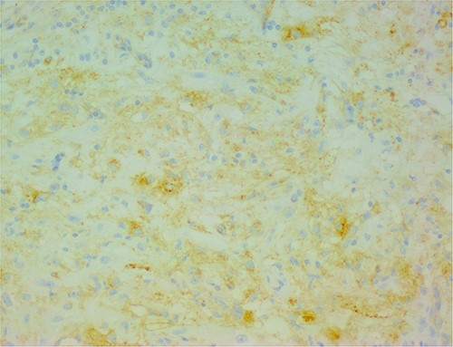 The neoplastic cells are also positive for HMB45, demonstrating the typical myo-melanocytic differentiation.