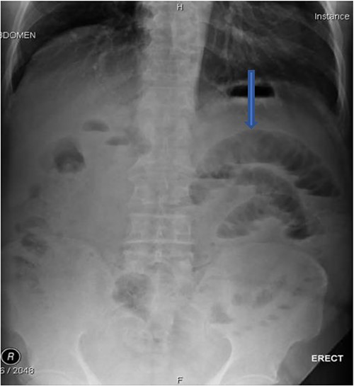 Erect film showing air-fluid levels.