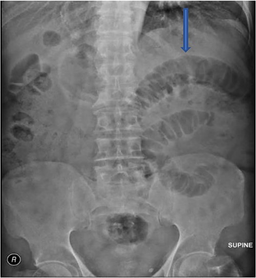 Supine film with small bowel dilatation.