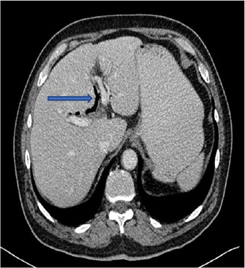 CT showing pneumobilia.