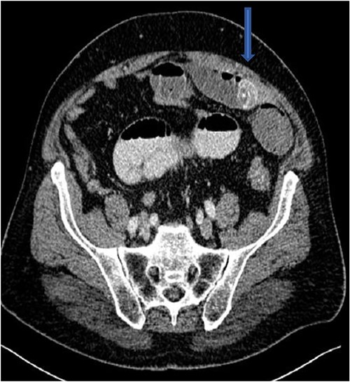 CT showing stone in distal jejunum.