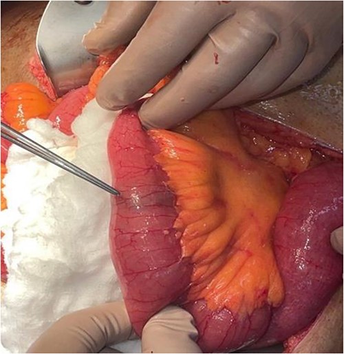 Stone in distal jejunum.