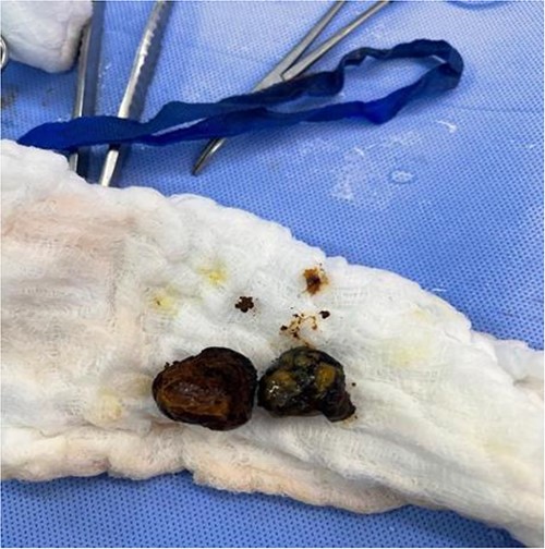 retrieved stone in two pieces with proximal dilatation.