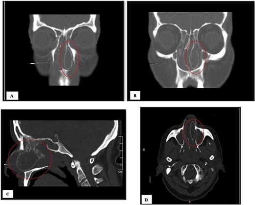 (A, B) CT of coronal view; (C) CT of sagittal view, and (D) CT of axial view.