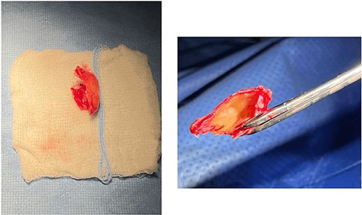 The giant concha bullosa after resection, which was obstructing the left nasal cavity.