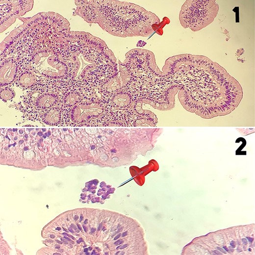 1-Low magnification histological section (HE ×40) showing a bulbous mucosa housing in surface the Sarcina ventriculi germ (pin) 2-High magnification microphotograph (HE ×400) revealing the presence of cuboid-shaped germs arranged in tetrads, corresponding to Sarcina ventriculi (pin).
