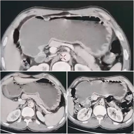 CT scan of the abdomen, which revealed marked dilatation of the stomach.