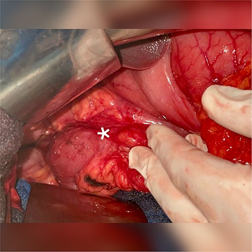 Individualization of the transition zone located at the level of the pylorus.