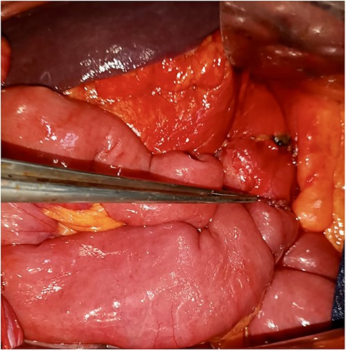 Gastroenteric anastomosis.