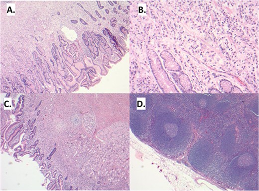 (A) Sections demonstrate an infiltrative lesion expanding the lamina propria of the gastric mucosa. Surface epithelium includes foci of intestinal metaplasia. (B) The infiltrative lesion is composed of signet ring tumor cells with irregular ovoid nuclei and abundant finely vacuolated cytoplasm present in a single cell distribution throughout all layers of the stomach wall including involvement of the serosa, greater and lesser omentum and duodenal mucosa (C). (D) Multiple lymph node metastases are also noted.