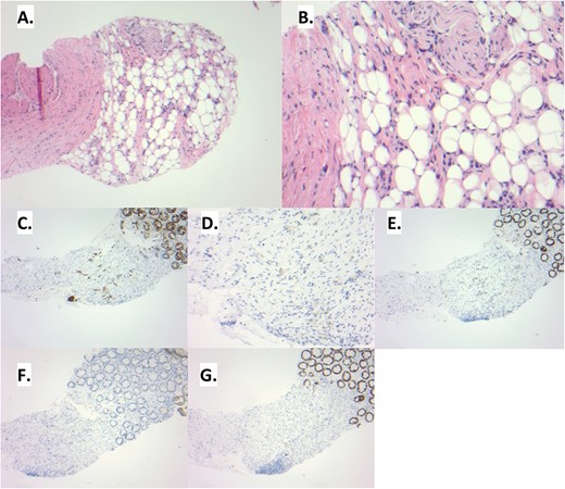 (A) The rectal biopsy shows distortion of the lamina propria. The overlying colonic epithelium appears benign. (B) Upon examination at higher power, signet ring cells can be noted within the loose connective and adipose tissue. These tumor cells are histologically similar to those seen in the prior gastrectomy. (C) This infiltrative pattern of tumor cells is highlighted by pankeratin. Additional immunohistochemistry is performed to delineate the site of origin of the signet ring cells. The tumor cells show an immunoprofile consistent with upper gastrointestinal tract origin: CK7 positive (D), CDX2 positive (E), CK20 negative (F), SATB2 negative (G).
