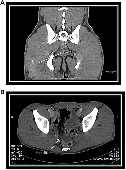 (A) Coronal CT scan section: arrow indicates free fluid in the Douglas pouch. (B) Axial CT scan section: arrow indicates free fluid in the Douglas pouch.