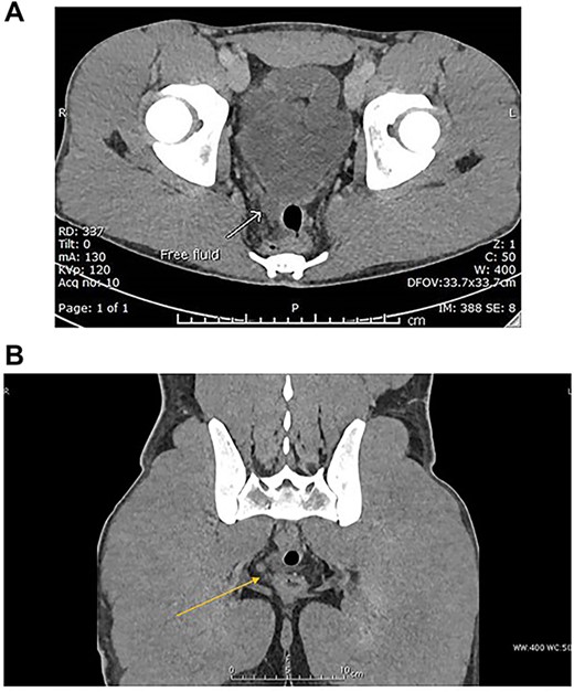 (A) Venous phase axial CT scan showing minimal amount of free fluid in the Douglas pouch (retro-vesical). (B) Venous phase coronal CT scan showing minimal amount of free fluid in the Douglas pouch (retro-vesical).