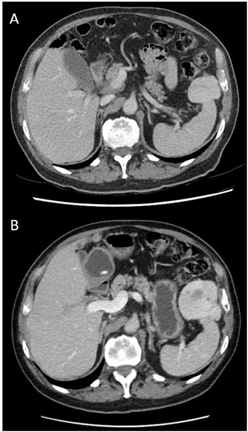 Axial views and comparison of original CT abdomen pelvis to 18-months later. (A) Contrast-enhanced CT abdomen pelvis (arterial phase): axial slice showing solid mass laterally in the left upper quadrant adjacent to the spleen measuring 49 × 39 mm2. The spleen is otherwise normal (B) Contrast-enhanced CT abdomen pelvis 18-months after original (arterial phase): Axial slice showing larger mass measuring 64 × 54 × 86 mm3 with persistent heterogeneous enhancement and prominent central area of decreased attenuation and peripheral cystic changes.